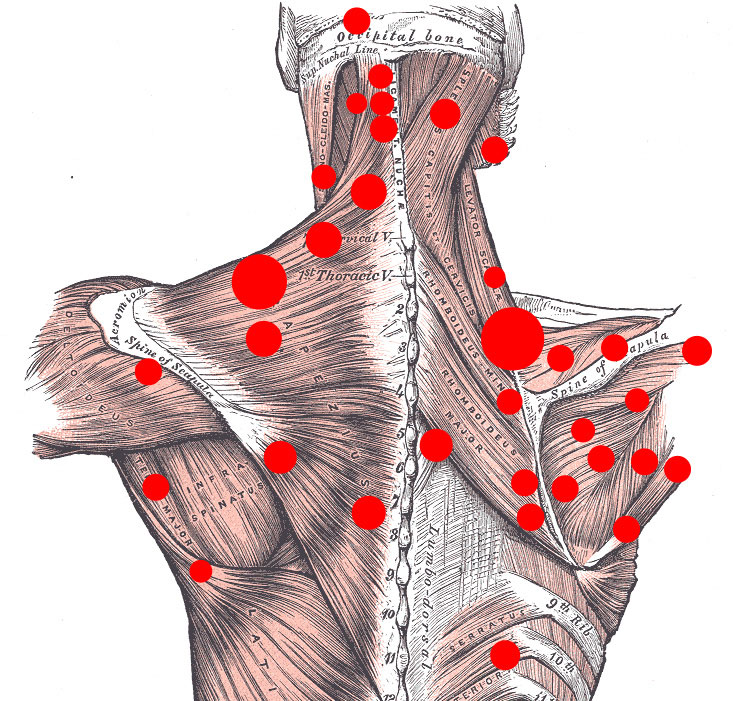 Afbeelding van een rug met diverse locaties voor manuele triggerpoints